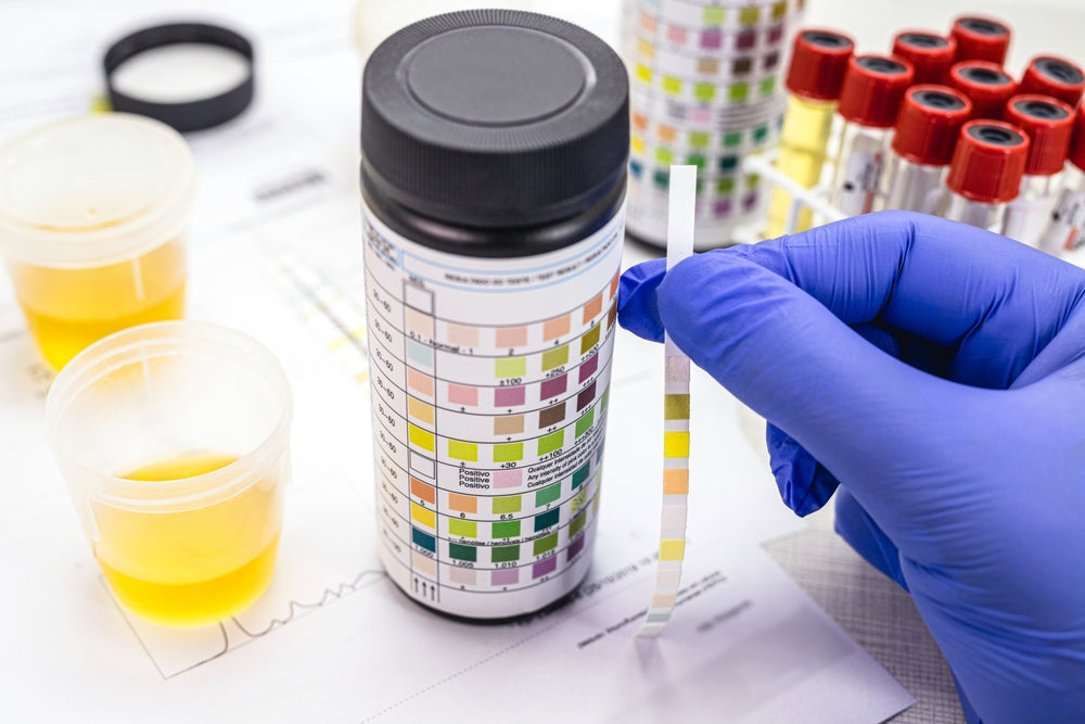 A gloved hand holds a color strip next to a container of urine and test results, with additional sample vials in the background, indicating a medical testing process.
