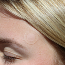 Close-up of a person's eye with a pimple patch on their face.