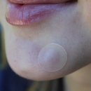 Close-up of a person's chin with a clear patch on their skin. For those deep, stubborn, hurts‑when‑you‑blink pimples 